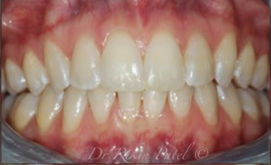 after-image