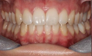 after-image