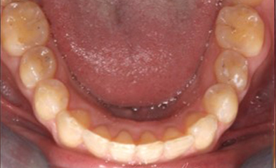 after-image