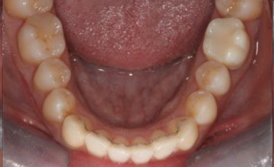 after-image