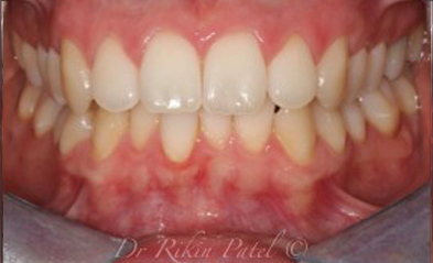 before-image