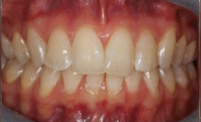 before-image