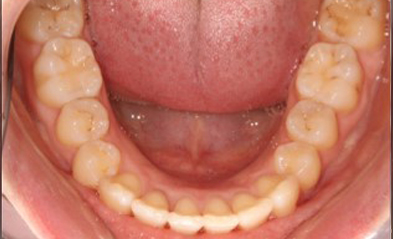 after-image