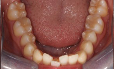 before-image
