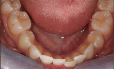 before-image