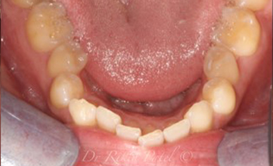 before-image