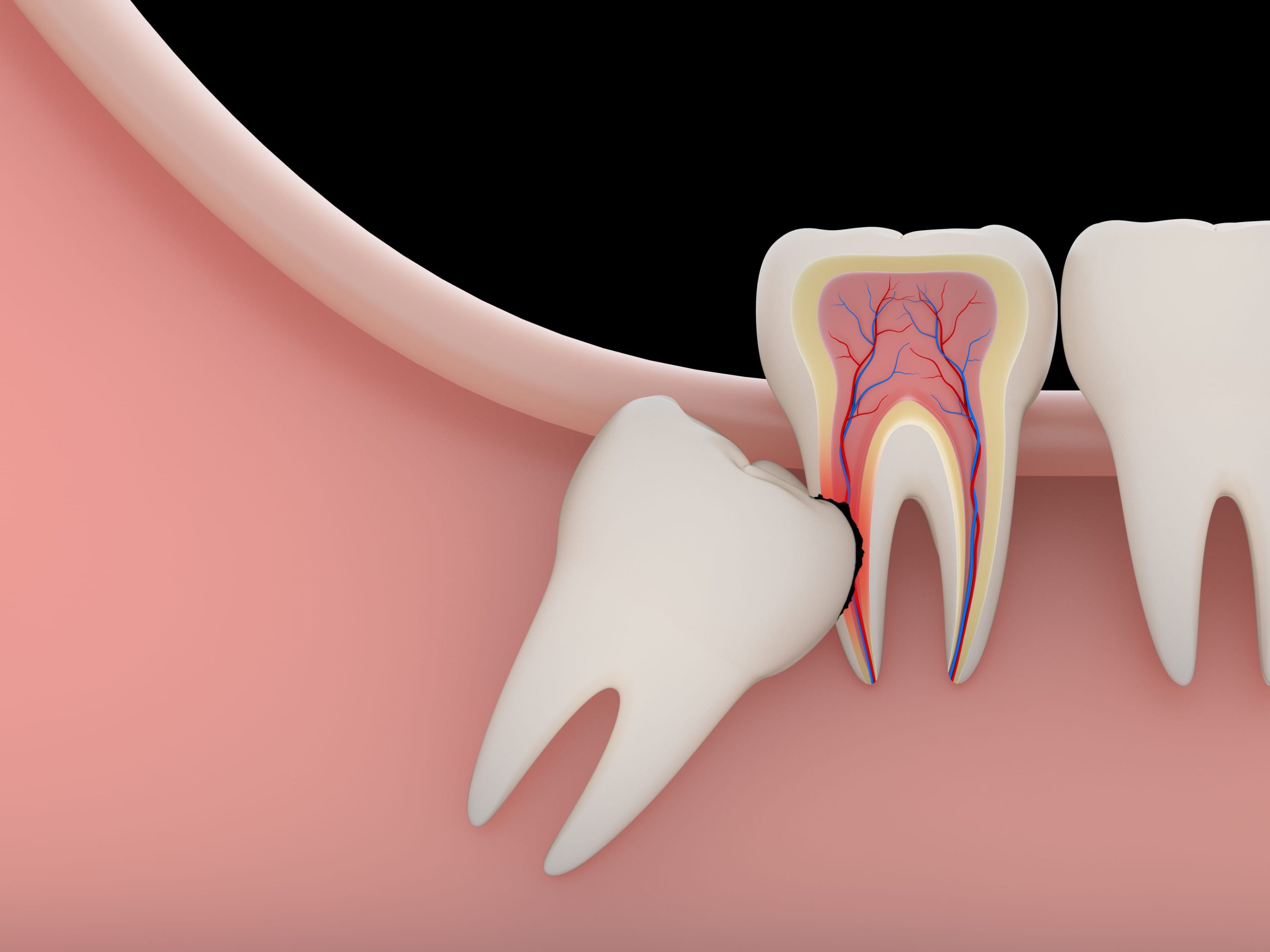 wisdom tooth DAS